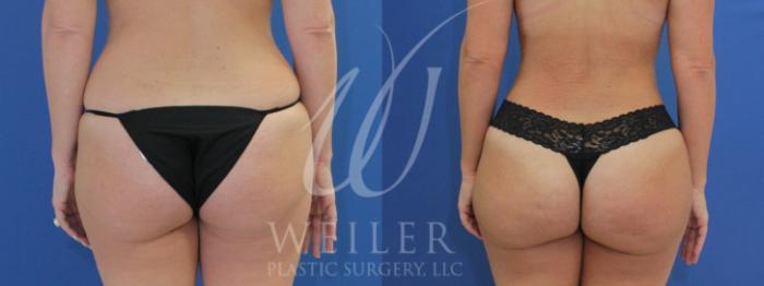 Before & After Brazilian Butt Lift Case 965 Back View in Baton Rouge, New Orleans, & Lafayette, Louisiana