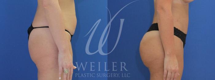 Before & After Brazilian Butt Lift Case 965 Right Side View in Baton Rouge, Louisiana
