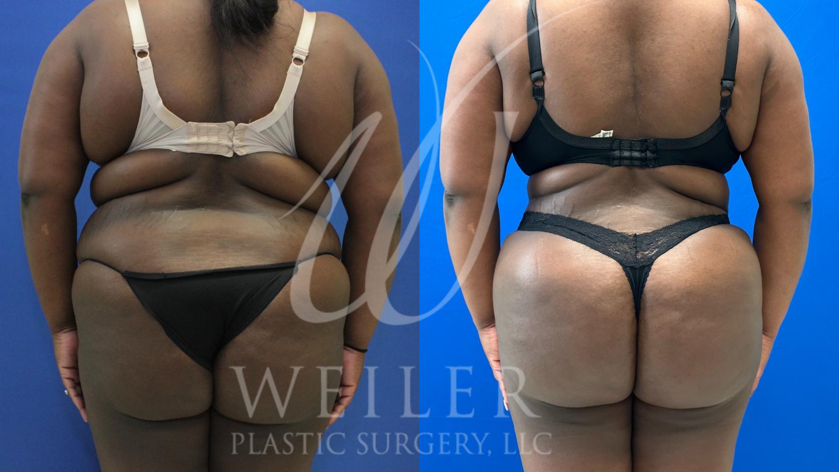 Before & After Brazilian Butt Lift Case 971 Back View in Baton Rouge, New Orleans, & Lafayette, Louisiana