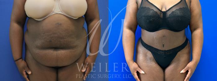 Before & After Brazilian Butt Lift Case 971 Front View in Baton Rouge, New Orleans, & Lafayette, Louisiana