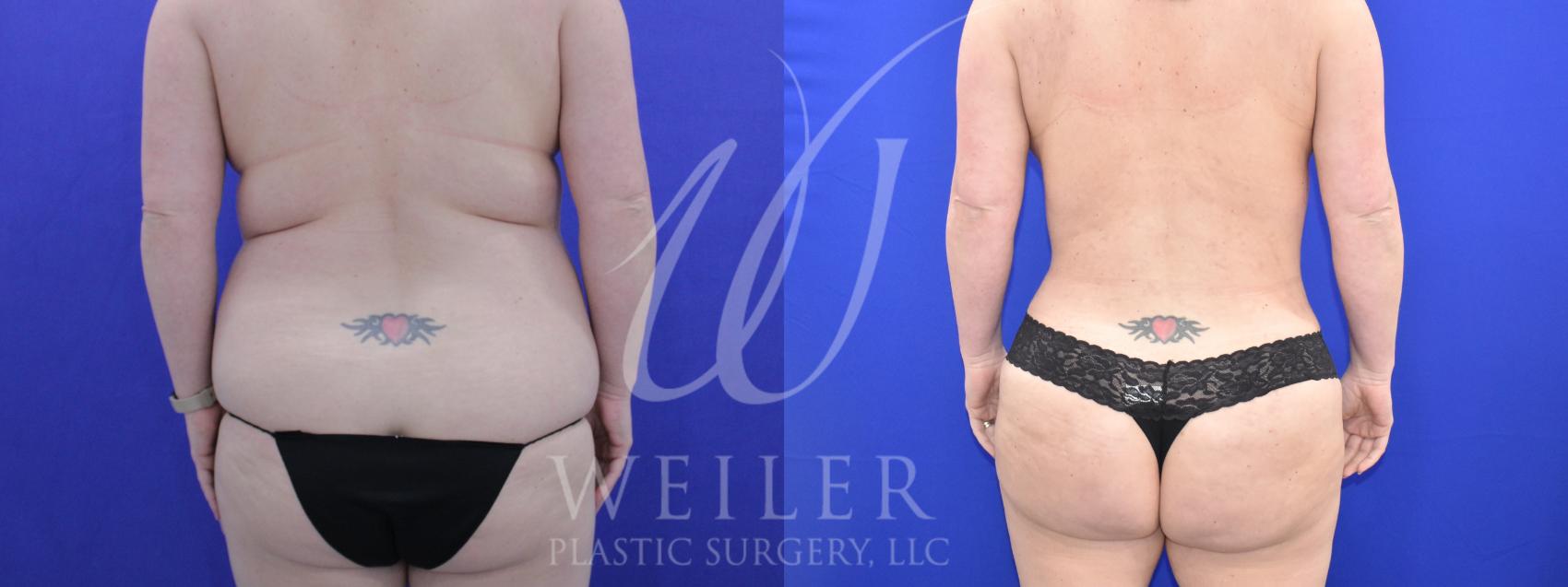 Before & After Brazilian Butt Lift Case 992 Back View in Baton Rouge, New Orleans, & Lafayette, Louisiana