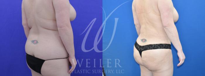 Before & After Brazilian Butt Lift Case 992 Right Oblique View in Baton Rouge, New Orleans, & Lafayette, Louisiana