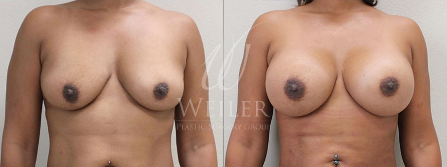Before & After Breast Augmentation Case 101 View #1 View in Baton Rouge, Louisiana