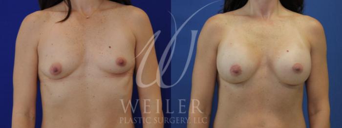 Before & After Breast Augmentation Case 1015 Front View in Baton Rouge, New Orleans, & Lafayette, Louisiana