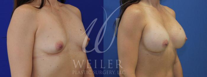 Before & After Breast Augmentation Case 1015 Right Oblique View in Baton Rouge, New Orleans, & Lafayette, Louisiana