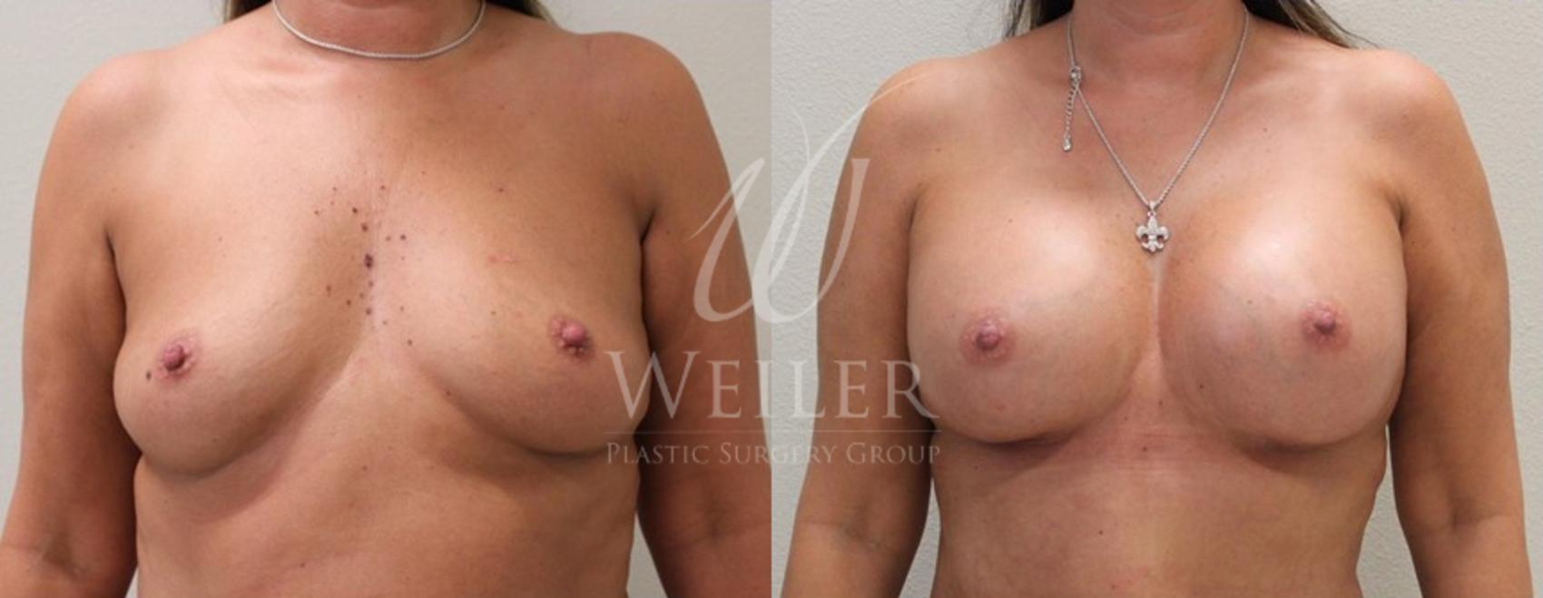 Before & After Breast Augmentation Case 102 View #1 View in Baton Rouge, Louisiana