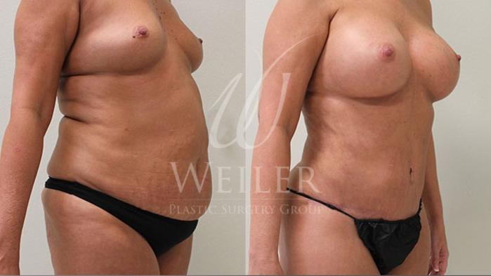 Before & After Breast Augmentation Case 102 View #2 View in Baton Rouge, New Orleans, & Lafayette, Louisiana
