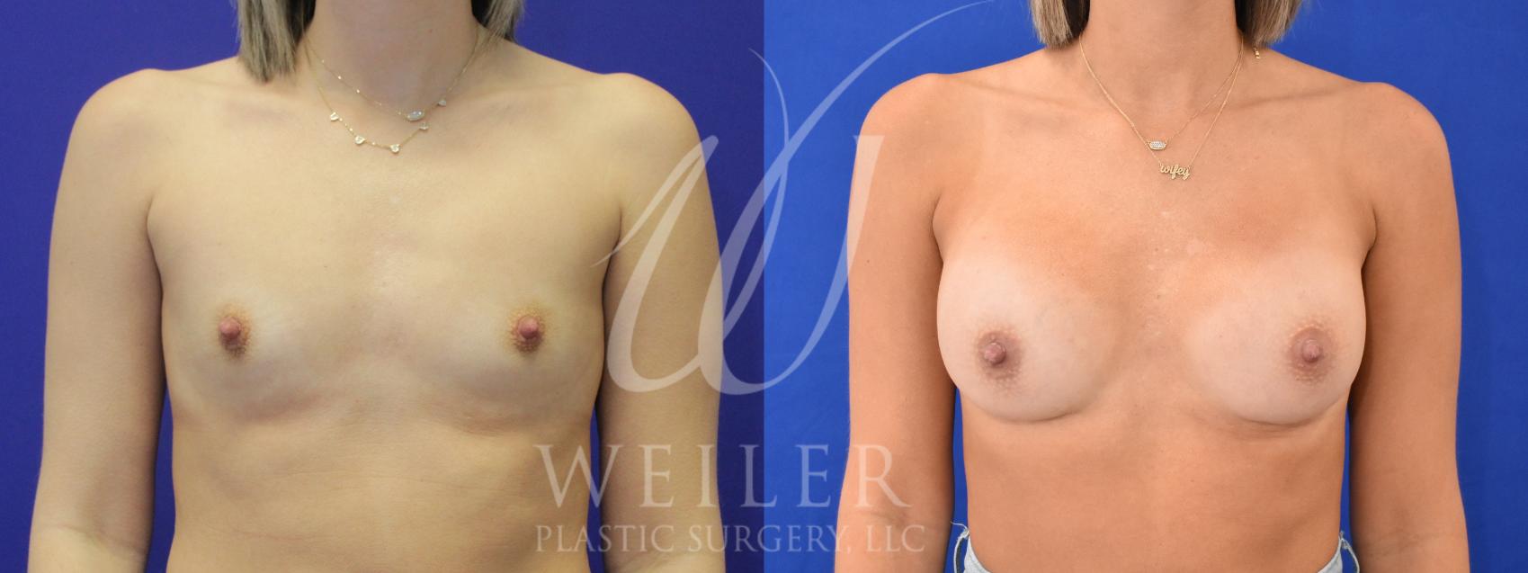 Before & After Breast Augmentation Case 1024 Front View in Baton Rouge, New Orleans, & Lafayette, Louisiana