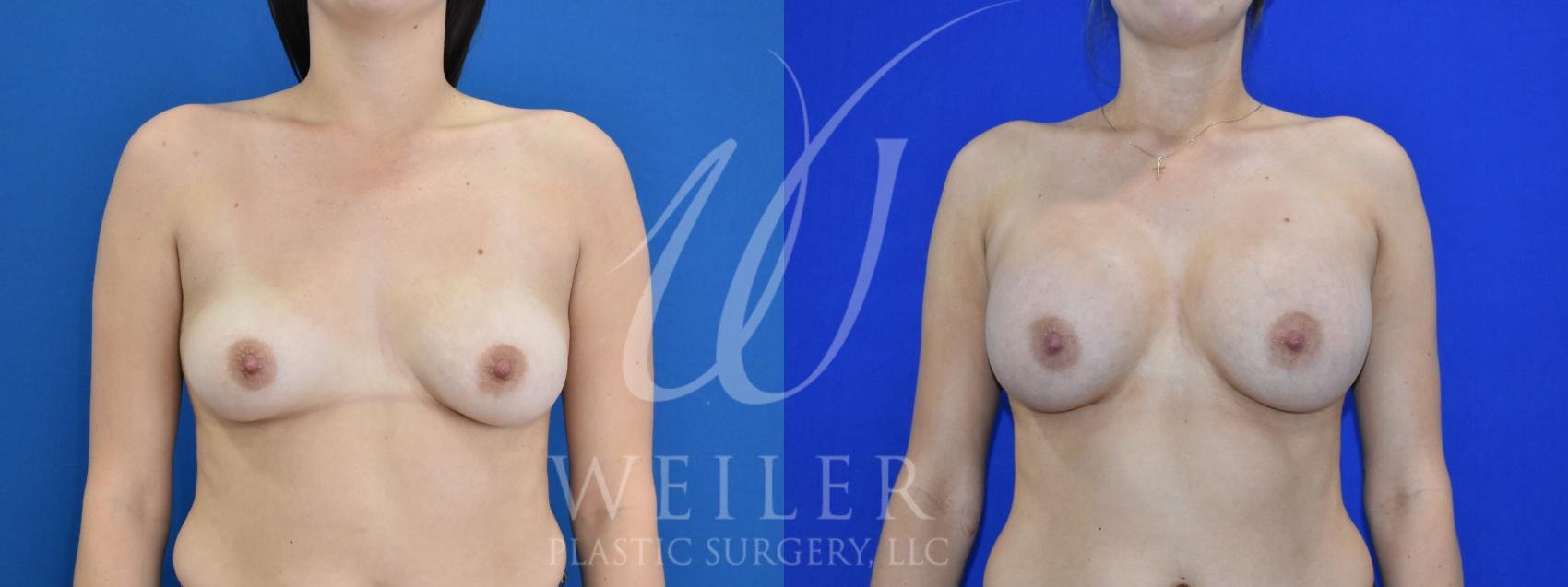 Before & After Breast Augmentation Case 1029 Front View in Baton Rouge, New Orleans, & Lafayette, Louisiana