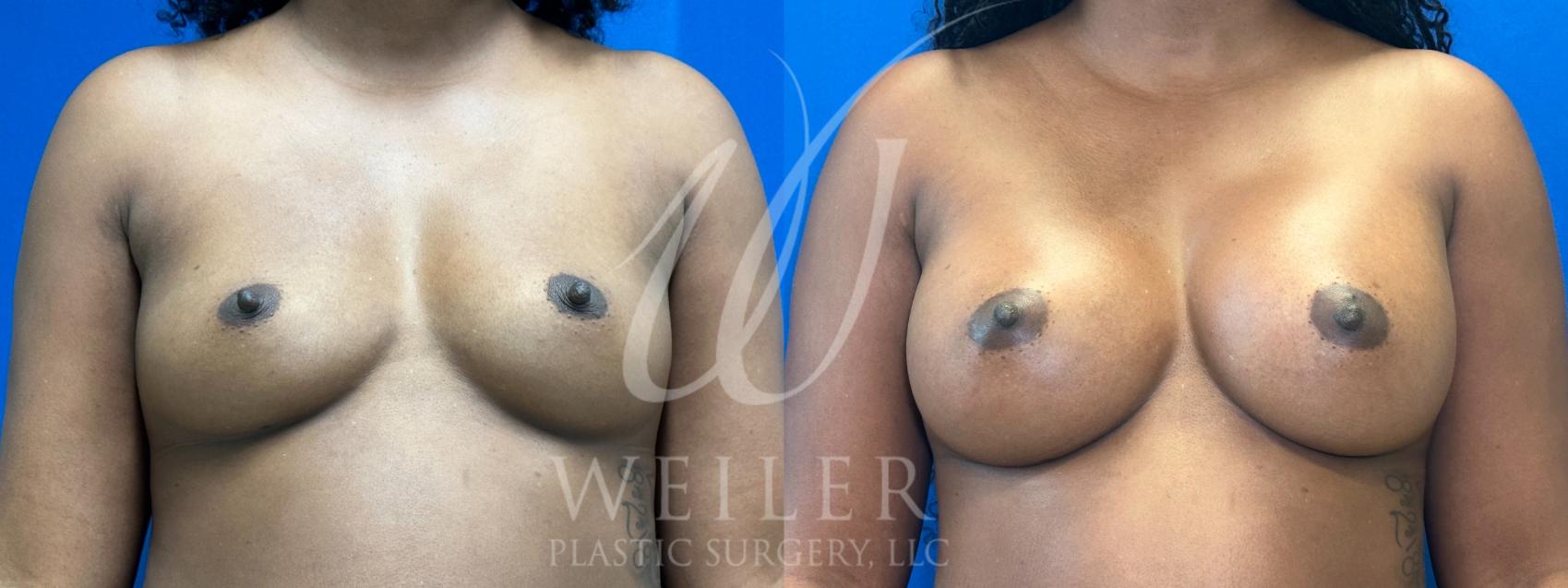 Before & After Breast Augmentation Case 1052 Front View in Baton Rouge, New Orleans, & Lafayette, Louisiana