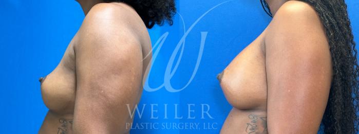 Before & After Breast Augmentation Case 1052 Left Side View in Baton Rouge, New Orleans, & Lafayette, Louisiana