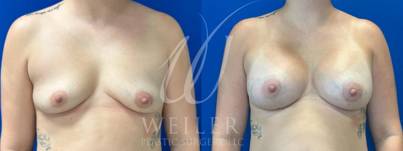 Before & After Breast Augmentation Case 1055 Front View in Baton Rouge, New Orleans, & Lafayette, Louisiana