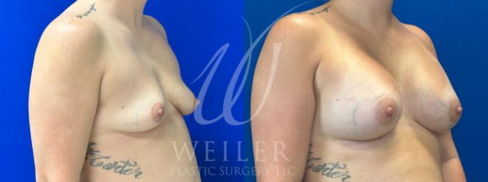 Before & After Breast Augmentation Case 1055 Right Oblique View in Baton Rouge, New Orleans, & Lafayette, Louisiana