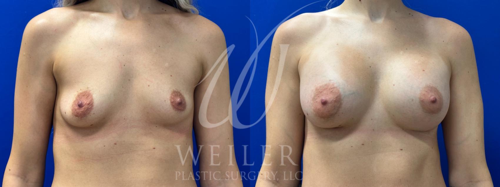 Before & After Breast Augmentation Case 1066 Front View in Baton Rouge, New Orleans, & Lafayette, Louisiana
