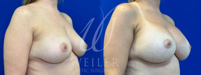 Before & After Breast Augmentation Case 1067 Right Oblique View in Baton Rouge, New Orleans, & Lafayette, Louisiana