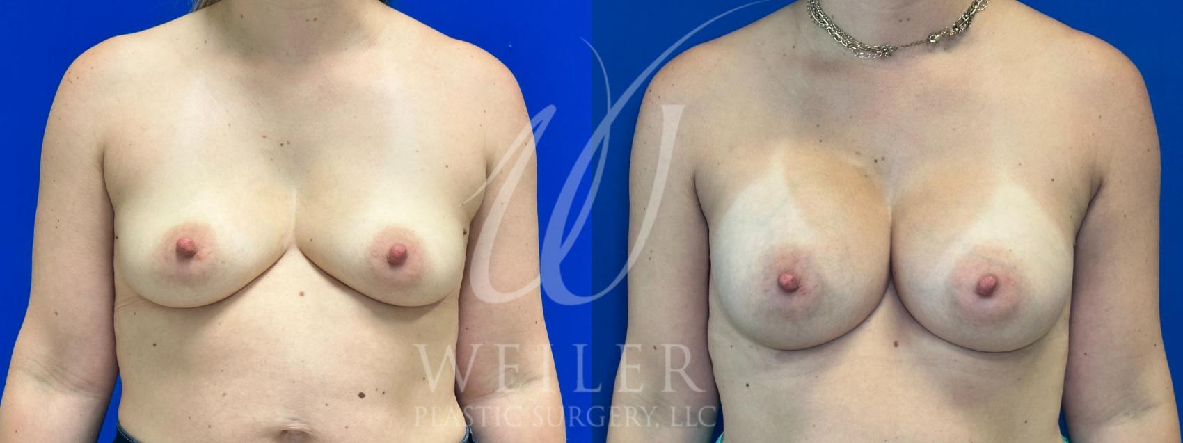 Before & After Breast Augmentation Case 1089 Front View in Baton Rouge, New Orleans, & Lafayette, Louisiana