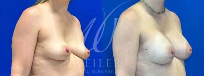 Before & After Breast Augmentation Case 1089 Right Oblique View in Baton Rouge, New Orleans, & Lafayette, Louisiana