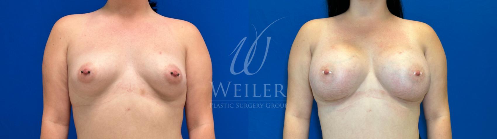 Before & After Breast Augmentation Case 1090 Front View in Baton Rouge, New Orleans, & Lafayette, Louisiana