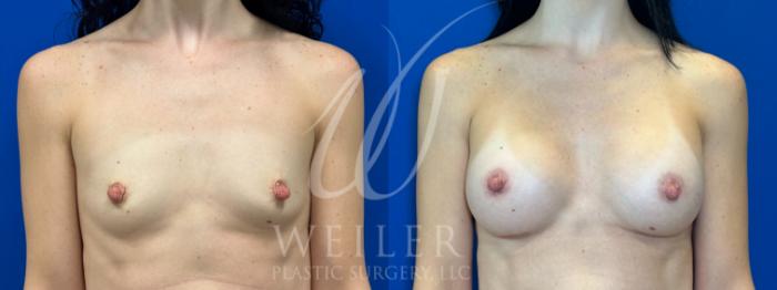 Before & After Breast Augmentation Case 1097 Front View in Baton Rouge, New Orleans, & Lafayette, Louisiana