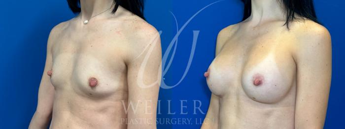 Before & After Breast Augmentation Case 1097 Left Oblique View in Baton Rouge, New Orleans, & Lafayette, Louisiana
