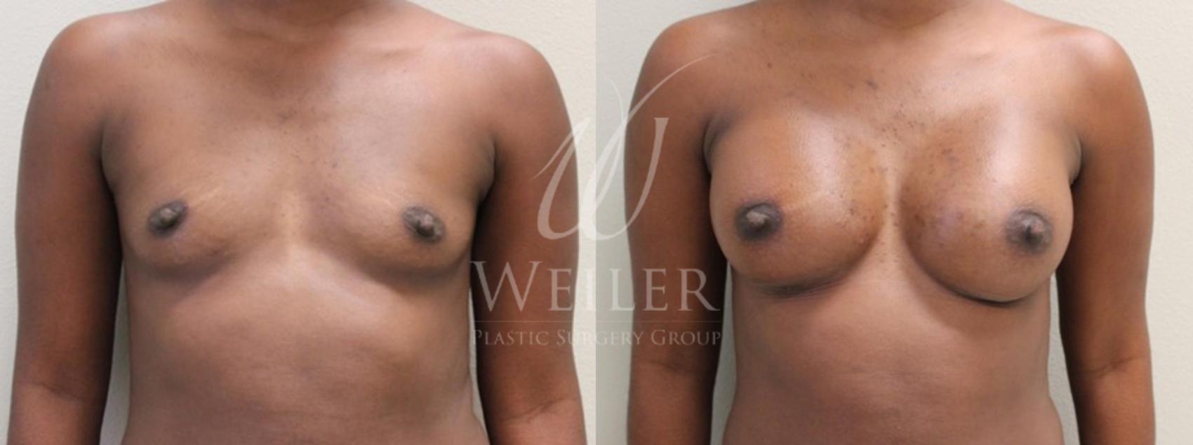 Before & After Breast Augmentation Case 110 View #1 View in Baton Rouge, New Orleans, & Lafayette, Louisiana