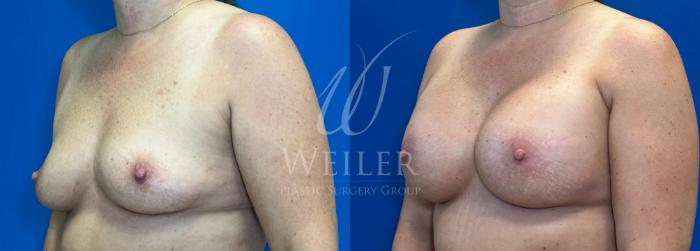 Before & After Breast Augmentation Case 1113 Left Side View in Baton Rouge, New Orleans, & Lafayette, Louisiana