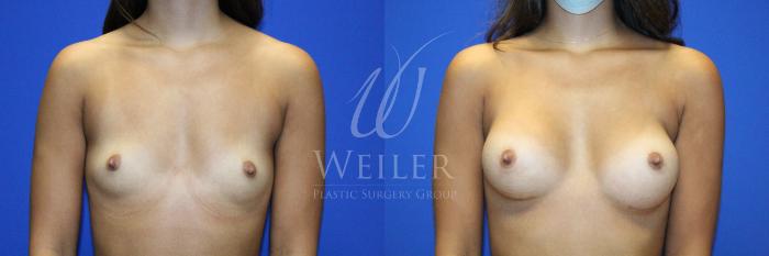 Before & After Breast Augmentation Case 1128 Front View in Baton Rouge, New Orleans, & Lafayette, Louisiana