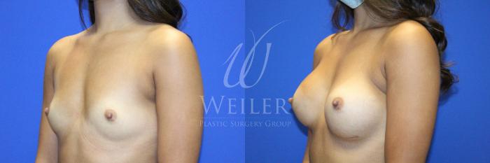 Before & After Breast Augmentation Case 1128 Right Side View in Baton Rouge, New Orleans, & Lafayette, Louisiana