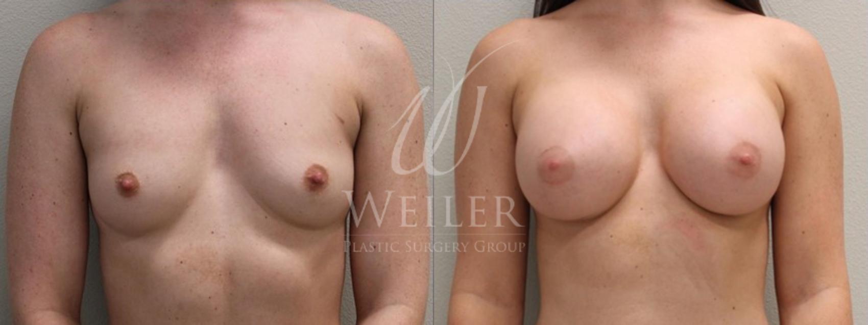 Before & After Breast Augmentation Case 113 View #1 View in Baton Rouge, Louisiana