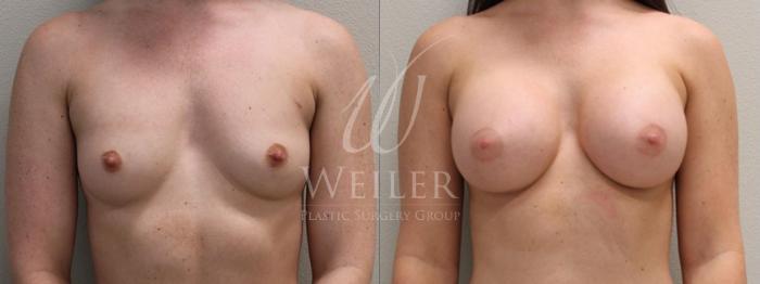 Before & After Breast Augmentation Case 113 View #1 View in Baton Rouge, New Orleans, & Lafayette, Louisiana
