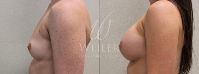 Before & After Breast Augmentation Case 113 View #2 View in Baton Rouge, New Orleans, & Lafayette, Louisiana