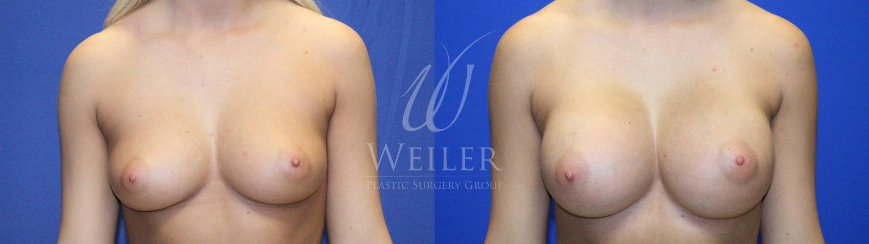 Before & After Breast Augmentation Case 1130 Front View in Baton Rouge, New Orleans, & Lafayette, Louisiana