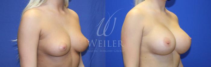 Before & After Breast Augmentation Case 1130 Left Oblique View in Baton Rouge, New Orleans, & Lafayette, Louisiana