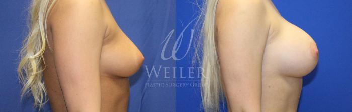 Before & After Breast Augmentation Case 1130 Left Side View in Baton Rouge, New Orleans, & Lafayette, Louisiana