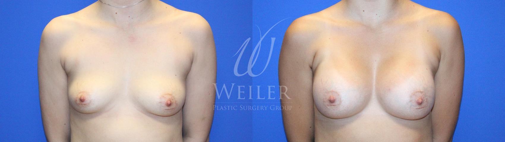 Before & After Breast Augmentation Case 1135 Front View in Baton Rouge, New Orleans, & Lafayette, Louisiana