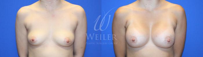 Before & After Breast Augmentation Case 1135 Front View in Baton Rouge, New Orleans, & Lafayette, Louisiana