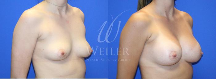 Before & After Breast Augmentation Case 1135 Left Oblique View in Baton Rouge, New Orleans, & Lafayette, Louisiana
