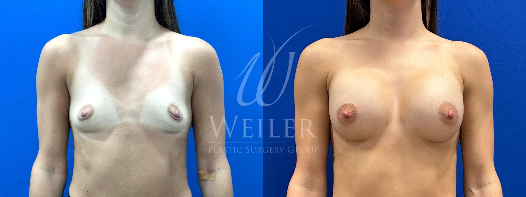 Before & After Breast Augmentation Case 1168 Front View in Baton Rouge, Louisiana