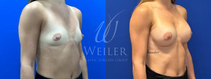 Before & After Breast Augmentation Case 1168 Right Oblique View in Baton Rouge, New Orleans, & Lafayette, Louisiana