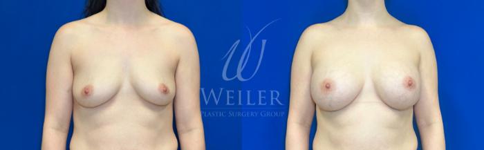 Before & After Breast Augmentation Case 1178 Front View in Baton Rouge, New Orleans, & Lafayette, Louisiana