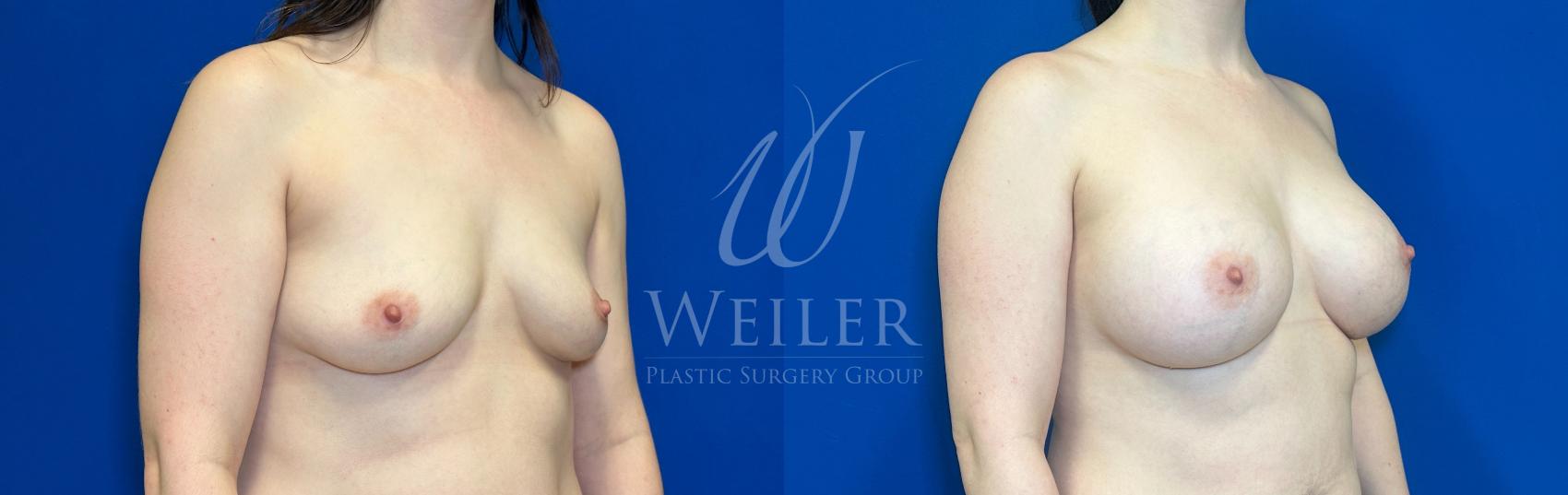 Before & After Breast Augmentation Case 1178 Right Oblique View in Baton Rouge, New Orleans, & Lafayette, Louisiana