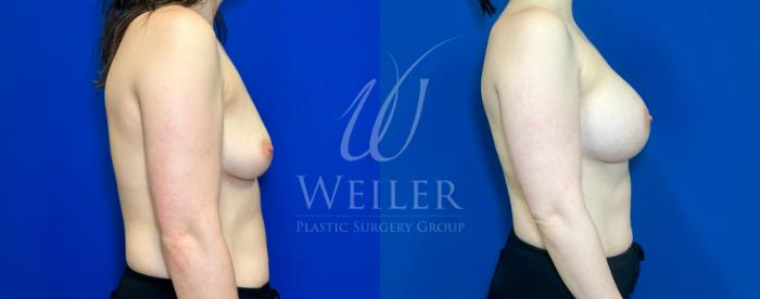 Before & After Breast Augmentation Case 1178 Right Side View in Baton Rouge, New Orleans, & Lafayette, Louisiana