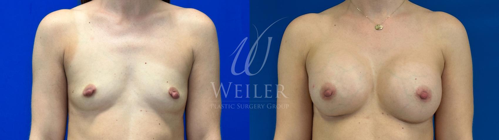 Before & After Breast Augmentation Case 1190 Front View in Baton Rouge, New Orleans, & Lafayette, Louisiana