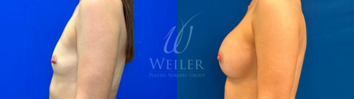 Before & After Breast Augmentation Case 1190 Right Side View in Baton Rouge, New Orleans, & Lafayette, Louisiana
