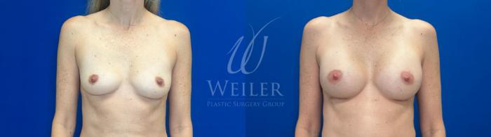 Before & After Breast Augmentation Case 1272 Front View in Baton Rouge, New Orleans, & Lafayette, Louisiana