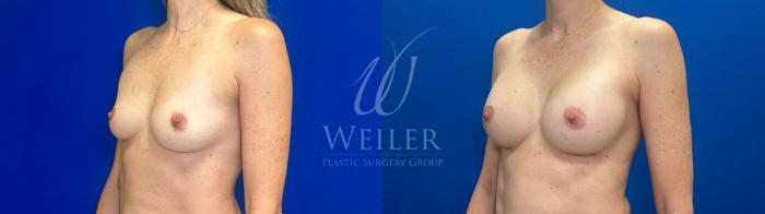 Before & After Breast Augmentation Case 1272 Right Oblique View in Baton Rouge, New Orleans, & Lafayette, Louisiana