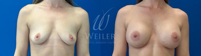 Before & After Breast Augmentation Case 1279 Front View in Baton Rouge, New Orleans, & Lafayette, Louisiana