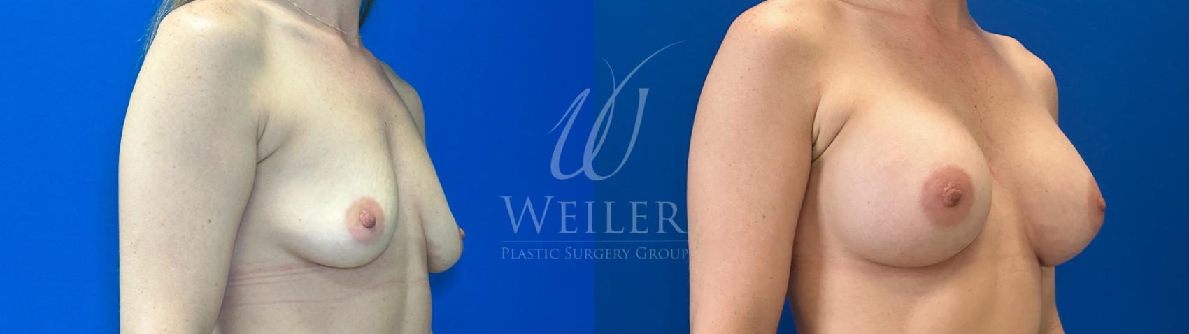 Before & After Breast Augmentation Case 1279 Left Oblique View in Baton Rouge, New Orleans, & Lafayette, Louisiana