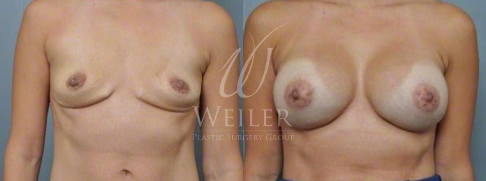 Before & After Breast Augmentation Case 128 View #1 View in Baton Rouge, New Orleans, & Lafayette, Louisiana