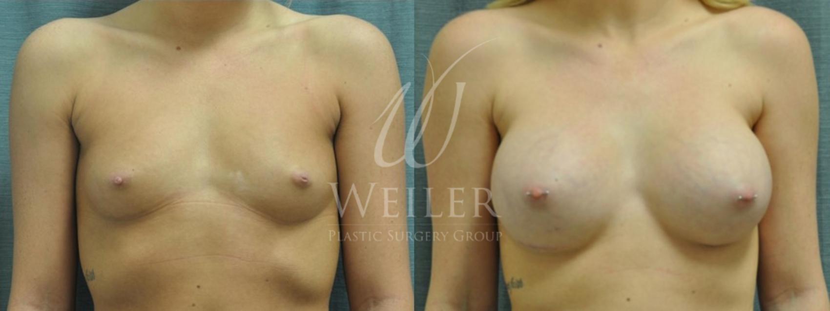Before & After Breast Augmentation Case 129 View #1 View in Baton Rouge, Louisiana